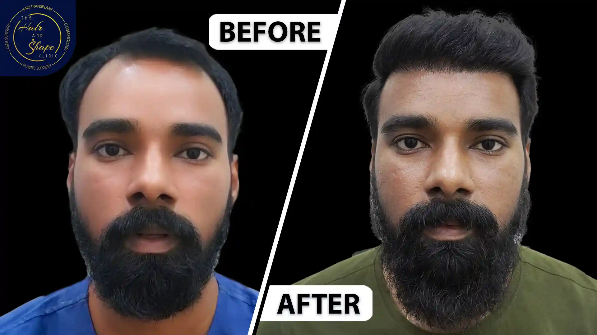 Hair Transplant result3